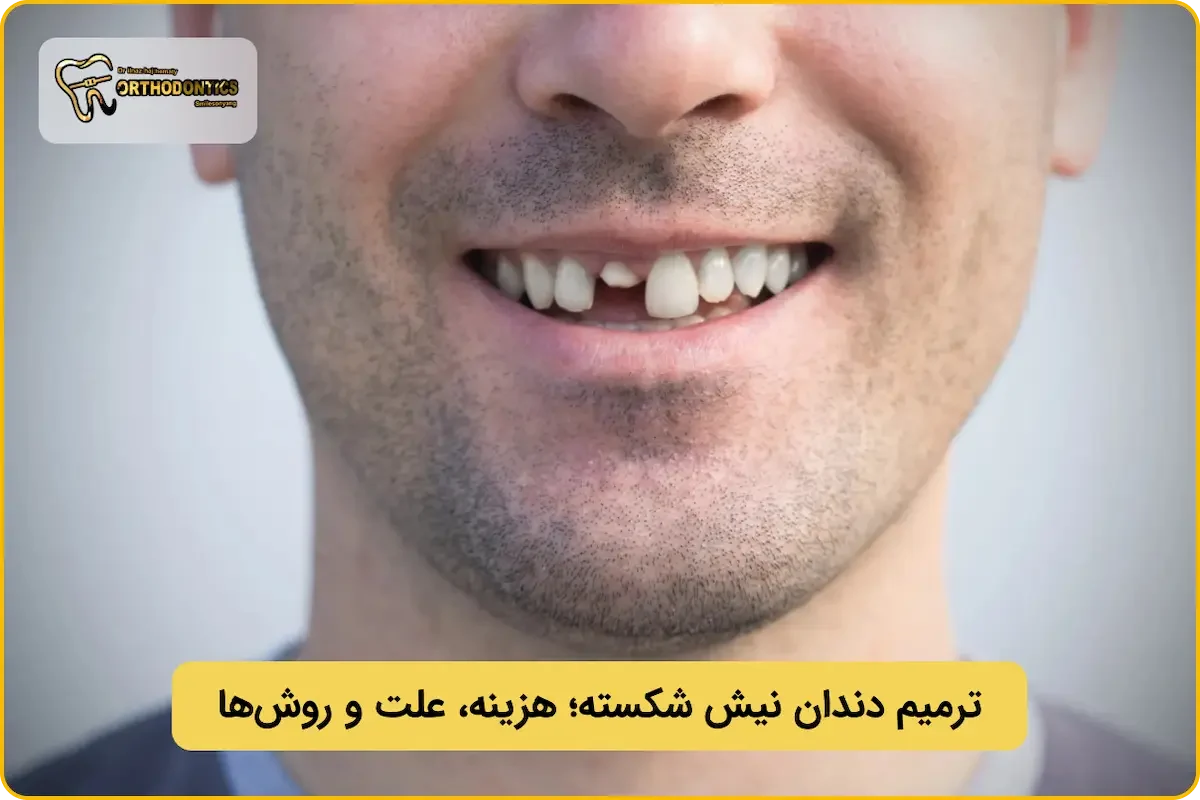 ترمیم دندان نیش شکسته