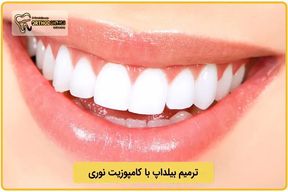 ترمیم بیلداپ با کامپوزیت نوری دندان دائمی